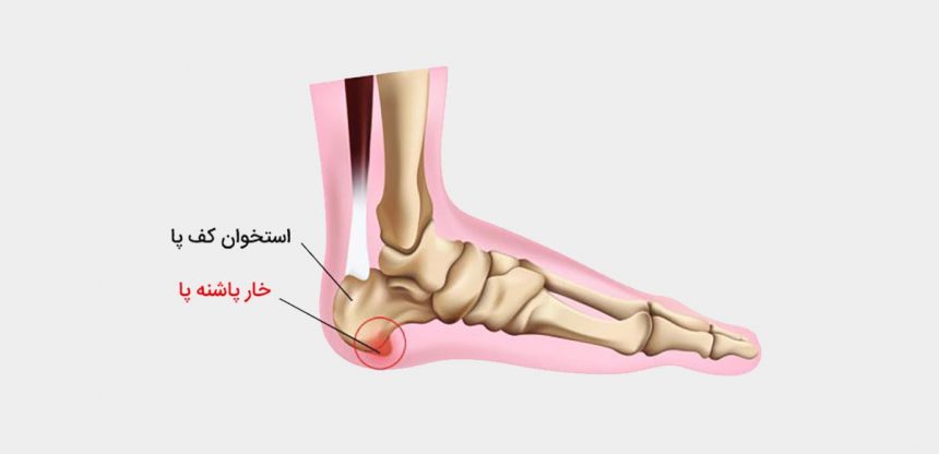 درمان خانگی خارپاشنه در مازندران