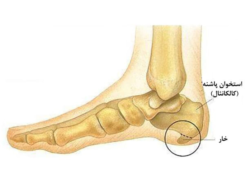 درمان-خار-پاشنه-در-بابل